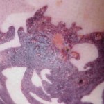 Allergic reactions to time tattoos on the basis of henna